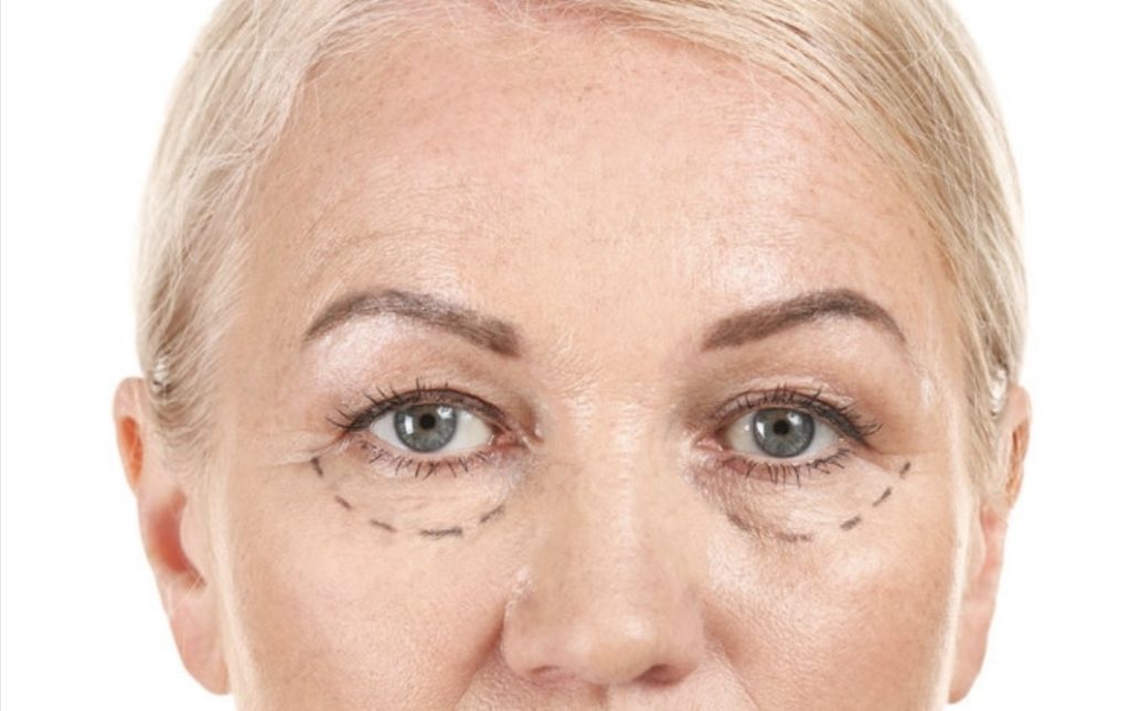 blefaroplastia inferior