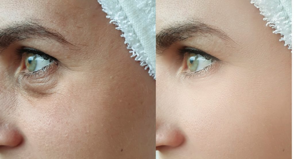 blefaroplastia inferior
