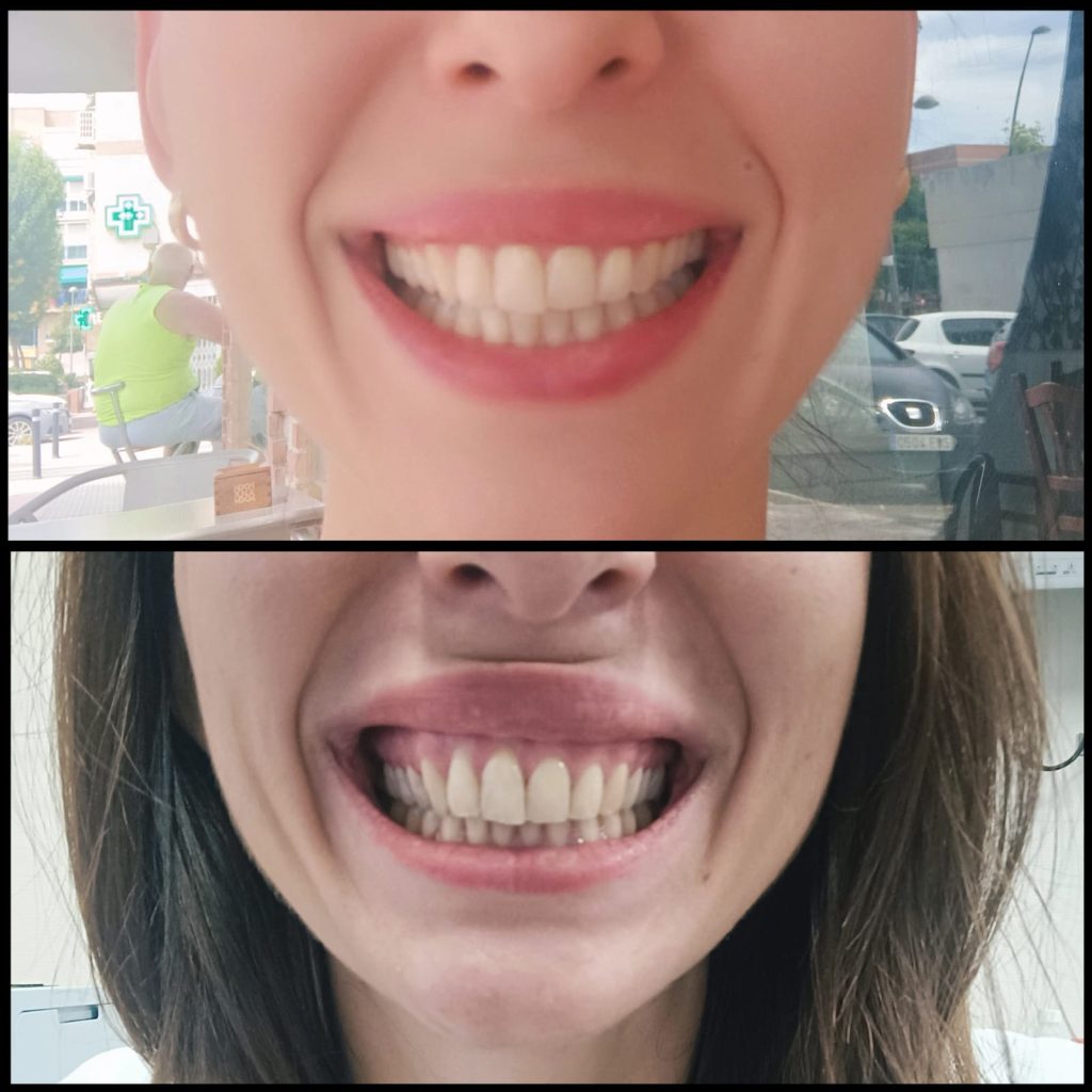 Corrección de sonrisa gingival