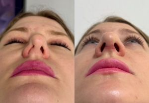 fosas nasales estrechas