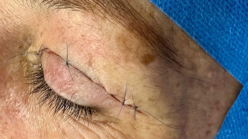 cuánto cuesta una operación de párpados caídos